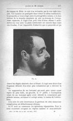 Fig. 2. [Mutilation faciale grave consécutive à une blessure de guerre. Destruction de l'os malaire  [...]