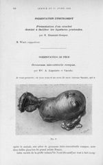 Fig. 1. [Grossesse interstitielle rompue]  - Bulletins et mémoires de la société nationale de chirur [...]