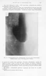 Fig. 3. — Gastro-gastrostomie. Radiographie cinq ans après l’intervention. Malade debout. Obs. II (P [...]