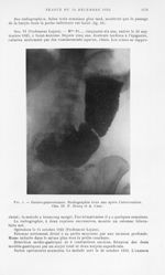 Fig. 4. — Gatro-gastrostomie. Radiographie trois ans après l’intervention. Obs. III P. Brocq et A. C [...]