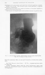 Fig. 5. — Gastrectomie annulaire. Radiographie trois ans après l’intervention. Obs. VII (P. Brocq, A [...]