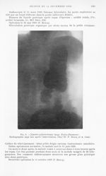 Fig. 6. — Gastro-pylorectomie large (Polya-Finsterer). Radiographie sept ans après l’intervention. O [...]