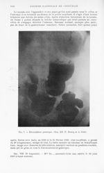 Fig. 7. — Biloculation gastrique. Obs. XII (P. Brocq et A. Cain) - Bulletins et mémoires de la socié [...]