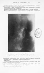 Fig. 8. — Gastro-pylorectomie large (Billroth 2e manière). Radiographie sept ans après. Obs. XII (P. [...]