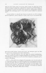 Fig. 1. [Grossesse extra-utérine tubaire à terme, puis spontanément ouverte dans l’intestin grêle et [...]