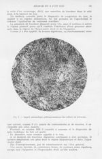 Fig. 1. — Aspect palissadique pathognomonique des cellules de Schwann - Mémoires de l'académie de ch [...]