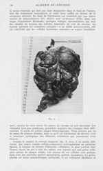 Fig. 1. [Sur un cas de schwannome du grêle]  - Mémoires de l'académie de chirurgie