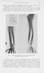 Fig. 2. — Maladie de Madelung : noter l’hémiatrophie interne de l’épiphyse radiale inférieure - Mémo [...]