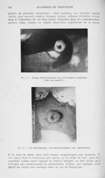 Fig. 1. — Image radiographique d’un schwannome gastrique (obs. personnelle) / Fig. 2. — Le schwannom [...]