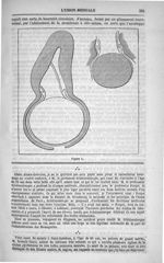 Figure 1. [Grossesse extra-utérine] Oeuf expulsé dans le col de l'utérus - L'Union médicale : journa [...]