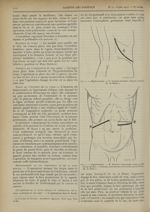 Fig. 1. Néphrectomie. - C. Incision lombaire (Guyon, Israël). [R. de Butler] / Fig. 2. Néphrectomie. [...]