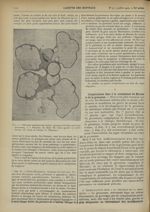 Fig. 1. Fibromes multiples de l'utérus ; grossesse de deux mois. (cas personnel) - Gazette des hôpit [...]