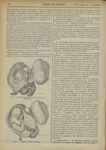 Fig. 2. Fibrome et grossesse (face antérieure). (Mouchotte) / Fig. 3. Coupe de l'utérus précédent -  [...]