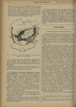 Fig. 2. Adhérences entre l'anse sigmoïde et la trompe gauche et grossesse tubaire gauche - Gazette d [...]