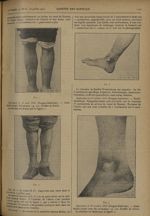 [Ulcères chroniques de la jambe traités par la méthode de Leriche] - Gazette des hôpitaux civils et  [...]