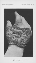 [Recherches sur l'alopécie atrophiante, variété pseudo-pelade par MM. L. Brocq, Lentlet et Ayrignac] [...]