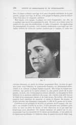 Fig. 1 [Deux cas de lupus de la face traites opératoirement par M. Morestin] - Annales de dermatolog [...]
