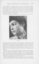 Fig. 2 [Deux cas de lupus de la face traités opératoirement par M. Morestin] - Annales de dermatolog [...]
