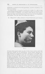 Fig. 3 [Deux cas de lupus de la face traites opératoirement par M. Morestin] - Annales de dermatolog [...]