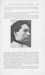 Fig. 4 [Deux cas de lupus de la face traites opératoirement par M. Morestin] - Annales de dermatolog [...]