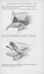 Fig. 2 / Fig. 3 [Épithélioma du gland traité par la décortication du gland ; présentation du malade  [...]