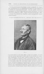 Fig. 2 [Rhinophyma opéré par l'abrasion modelante par M. Morestin] - Annales de dermatologie et de s [...]