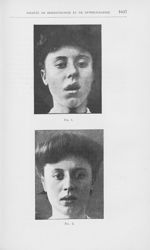 Fig. 1 / Fig. 2 [Angiomes des lèvres par M. Morestin] - Annales de dermatologie et de syphiligraphie