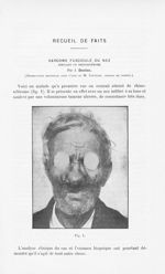 Fig. 1 [Sarcome fasciculé du nez simulant un rhinosclérome par J. Darier] - Annales de dermatologie  [...]