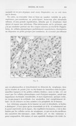 Fig. 2 [Lymphosarcome ulcéré de la lèvre (Ou sarcome atypique à cellules polymorphes) ressemblant a  [...]