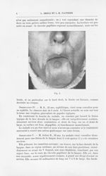 Fig. 1 [Glossite losangique médiane de la face dorsale de la langue par MM. L. Brocq et L.-M. Pautri [...]