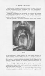 Fig. 2 [Glossite losangique médiane de la face dorsale de la langue par MM. L. Brocq et L.-M. Pautri [...]