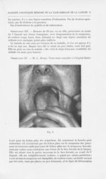 Fig. 3 [Glossite losangique médiane de la face dorsale de la langue par MM. L. Brocq et L.-M. Pautri [...]