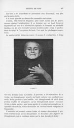 Figure 1 [Considérations sur l'étiologie de cette maladie par M. Aurel A Babès] - Annales de dermato [...]