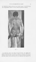 Fig. 1 [Un cas de dermatose de Darier (Psorospermose folliculaire végétante) par J.-D. Kayser et le  [...]