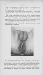 Fig. 1 [Contribution à l'étude de la pathogénie du soi-disant syphilome ano-rectal (Fournier) par Dr [...]