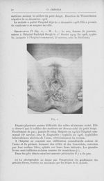 Fig. 2 [Contribution à l'étude de la pathogénie du soi-disant syphilome ano-rectal (Fournier) par Dr [...]