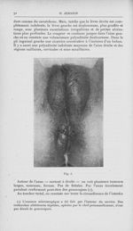 Fig. 3 [Contribution à l'étude de la pathogénie du soi-disant syphilome ano-rectal (Fournier) par Dr [...]