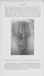 Fig. 4 [Contribution à l'étude de la pathogénie du soi-disant syphilome ano-rectal (Fournier) par Dr [...]