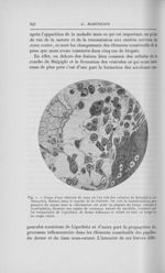 Fig. 1. — Coupe d'une vésicule de zona où l’on voit des cellules de malpighi (C. M.)dissociées, flot [...]