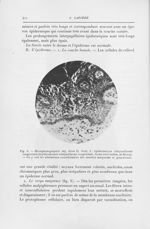 Fig. 6. — Microphotographie obj. Zeiss d, ocul. 3 : épidermolyse ichtyosiforme congénitale (Érythrod [...]