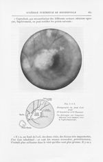 Fig. 5 et 6. Photographie du fond d'oeil droit (Pr Jeandelize et Dr Thomas)  - Annales de dermatolog [...]