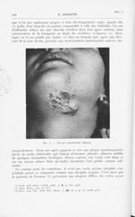 Fig. 3. — Naevus comédonien (Brocq)  - Annales de dermatologie et de syphiligraphie. Bulletin de la  [...]