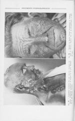 Fig. 77. — Syphilides tertiaires du cuir chevelu, Gommes du thorax. Syphilome gommeux en nappes de l [...]