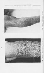 Fig.. 90 — Maladie de Darier (Jambe) (Y. Bureau, Nantes)  - Annales de dermatologie et de syphiligra [...]