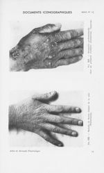Fig. 112. — Maladie de Darier (Femme de 30 ans) (Weissenbach) / Fig. 113. — Dermatite professionnell [...]