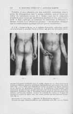 Fig. 1 / Fig. 2 [Polynévrite cutanée nodulaire, chronique, allergique (Prurigo nodulaire de hyde) pa [...]