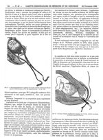 Fig. 2. Forceps régulièrement appliqué sur la tête retenue au-dessus du détroit supérieur (Baudelocq [...]