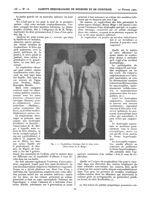 Fig. 1 - Trophoedème chronique chez les deux soeurs (Obesrvations de H. Meige.) - Gazette hebdomadai [...]