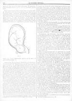 Fig. 67 [De la situation des oeufs et des foetus dans la grossesse gémellaire et des symptômes qui e [...]