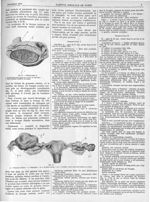 Fig. 8 (Observation I) / Fig. 9. [Grossesse tubaire] - Gazette médicale de Paris : journal de médeci [...]